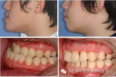 成人颌位矫正视频,揭秘矫正过程与技巧